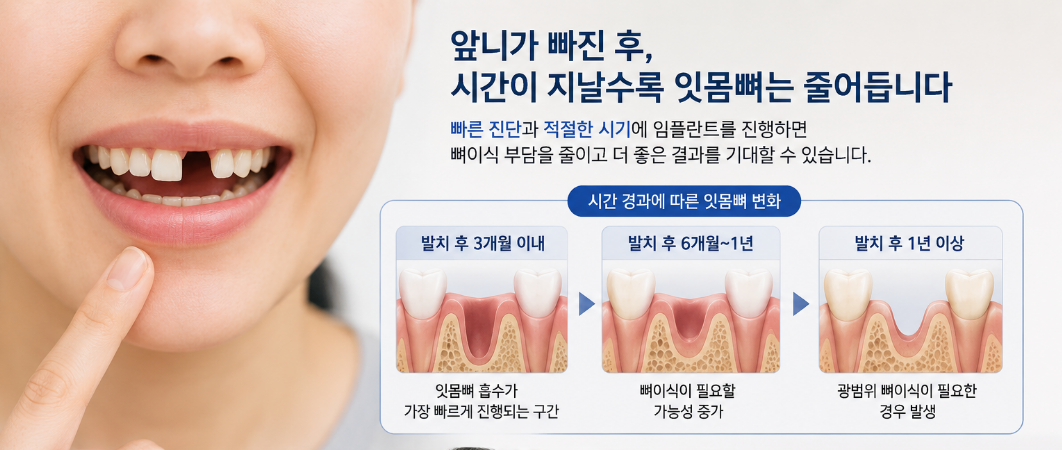 앞니 빠진 후 잇몸뼈 흡수 - 춘천 앞니 임플란트