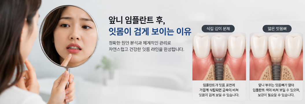 앞니 임플란트 잇몸 라인 관리 - 춘천서울부부치과