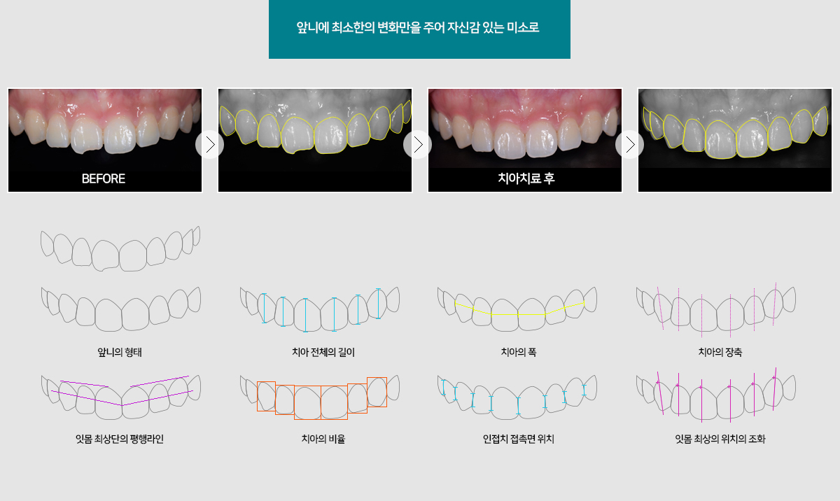 앞니에 최소한의 변화만을 주어 자신감 있는 미소로