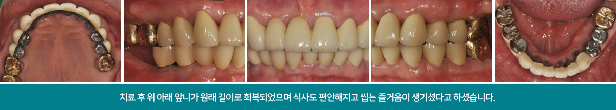 치료 후 모습을 보시면 위아래 앞니 물리시는 모습도 자연스럽고 치아의 높이도 회복되어 식사가 가능하십니다.