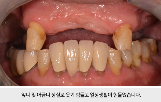 앞니 상실로 일상생활이 힘드렸습니다.