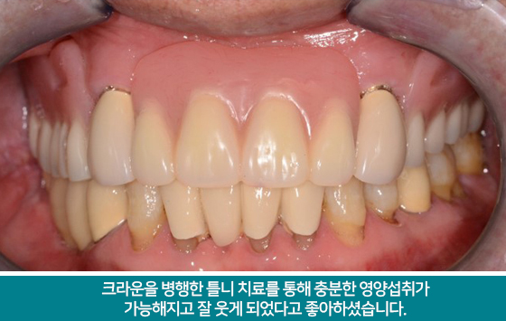 크라운치료와 틀니치료가 같이 진행 하였습니다.