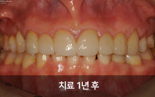 치료1년후