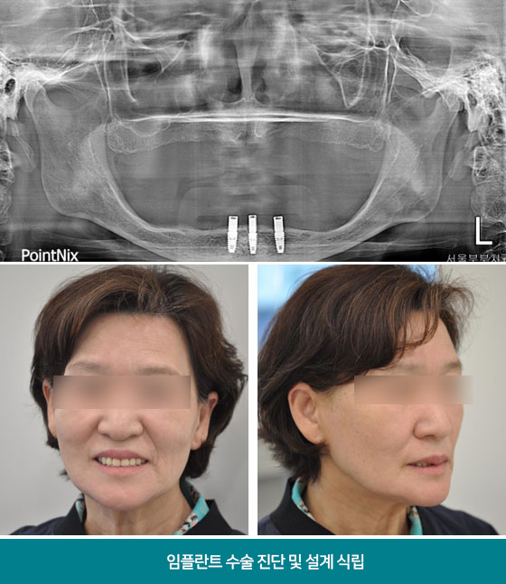 임플란트 수술 진단 및 설계, 식립