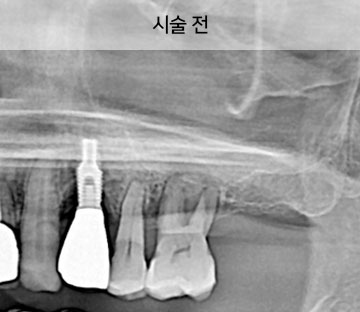 시술전