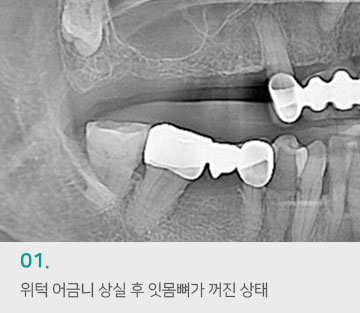 01 위턱 어금니 상실 후 잇못뻐가 꺼진 상태