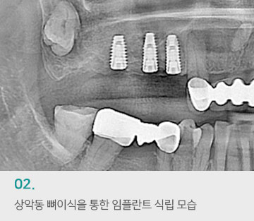 02 상악동 뼈이식을 통한 임플란트 식립 모습