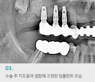 03 수술 후 치조골과 결합돼 고정된 임플란트 모습