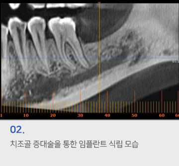 02 치조골 증대술을 통한 임플란트 식립 모습