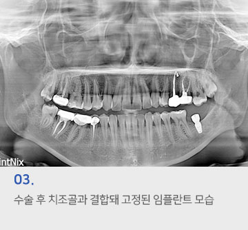 03 수술 후 치조골과 결합돼 고정된 임플란트 모습