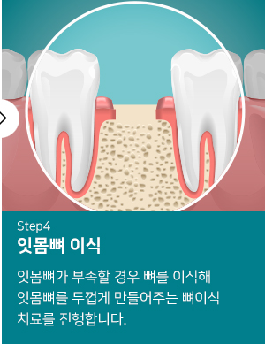 잇몸뼈 이식