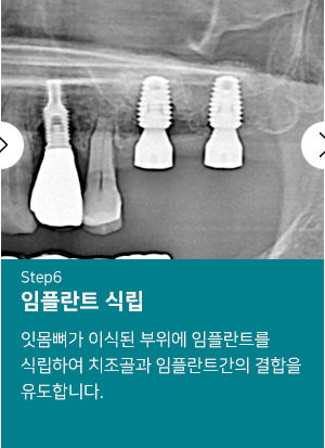 임플란트 식립