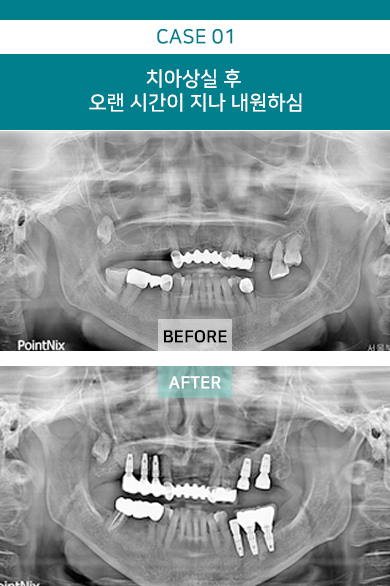 치아상실 후 오랜 시간이 지나 내원하심