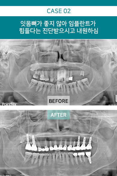 잇몸뼈가 좋지 않아 임플란트가 힘들다는 진단받으시고 내원하심