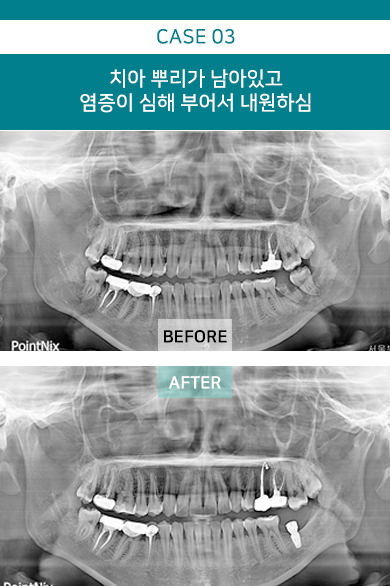 치아 뿌리가 남아있고염증이 심해 부어서 내원하심