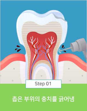 좁은 부위의 충치를 긁어냄