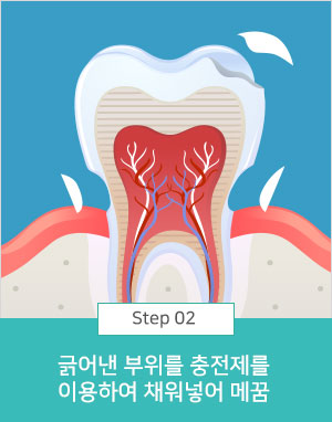 긁어낸 부위를 충전제를 이용하여 채워넣어 메꿈