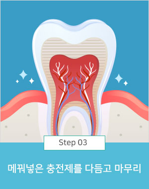 메꿔넣은 충전제를 다듬고 마무리