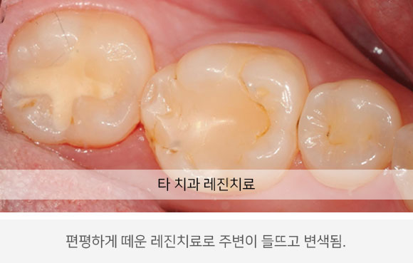 타 치과 레진치료 편평하게 떼운 레진치료로 주변이 들뜨고 변색됨.