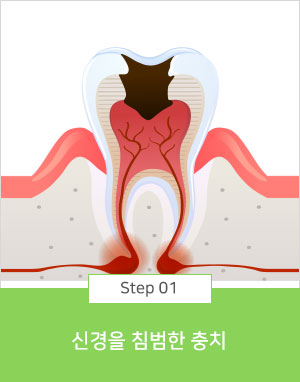 신경을 침범한 충치