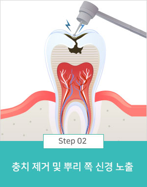 충치 제거 및 뿌리 쪽 신경 노출