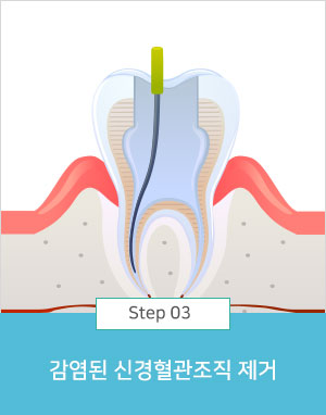 감염된 신경혈관조직 제거