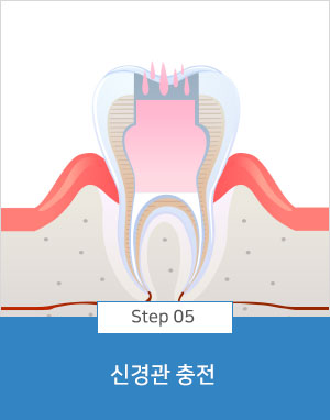 신경관 충전