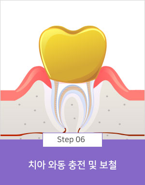 치아 와동 충전 및 보철