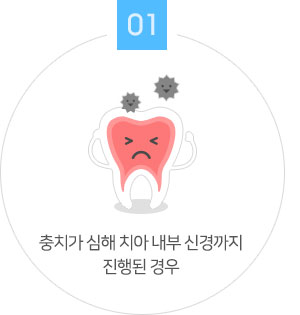 충치가 심해 치아 내부 신경까지 진행된 경우