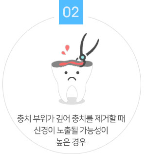 충치 부위가 깊어 충치를 제거할 때 신경이 노출될 가능성이 높은 경우