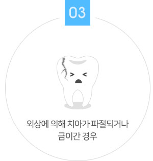 외상에 의해 치아가 파절되거나 금이간 경우