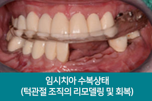 임시차아 수복상태